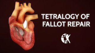 Tetralogy of Fallot Repair  Cincinnati Childrens [upl. by Pronty347]