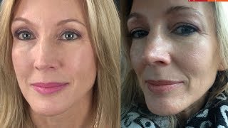 My Experience With Botox amp Filler Juvederm [upl. by Bandler]