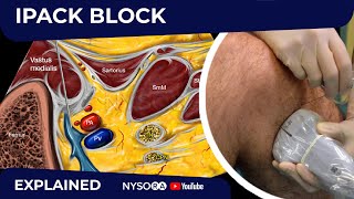 IPACK Block  Regional anesthesia Crash course with Dr Hadzic [upl. by Wade]