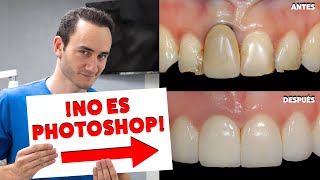 ¡CORREGIMOS UNA ENCÍA RETRAIDA SIN CIRUGIA  Una Alternativa a los injertos  NO ES PHOTOSHOP [upl. by Aciretnahs416]