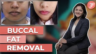 Buccal Fat Removal Surgery Recovery amp Results  Face or Cheek Fat Removal  Dr Shilpi Bhadani [upl. by Witcher]