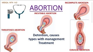 Abortion in hindi causestypesmanagement spontaneous abortion in hindithreatend abortion [upl. by Johnson]