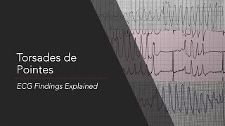 Torsades de Pointes ECG Findings Explained [upl. by Ennayrb]