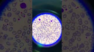 thalassemia peripheral blood smears with hypochromic microcytic red blood cells and poikilocytosis [upl. by Aronoh]