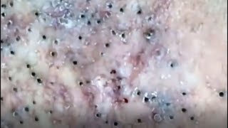 Blackheads removal from face  blackhead removal  acne 2019 [upl. by Laughry]