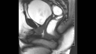 DEFECOGRAFIA RECTOCELE URETRA MG [upl. by Pollard]