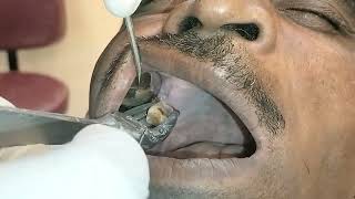 Painless Teeth Removal  Painless Tooth Extraction  Painless Maxillary Molar Extraction [upl. by Hafler]