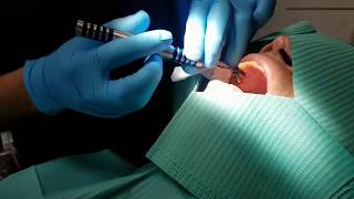 Dental Extraction using flexible NiTi Periotome VLOG Episode 3 [upl. by Desdamonna863]