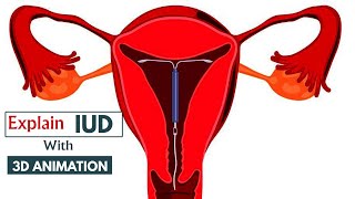 How does an IUD work  Understanding IUDs  Animated Guide  3D animation [upl. by Anilev]