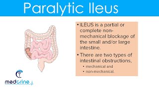 Paralytic Ileus  causes pathophysiology clinical features diagnosis and treatment [upl. by Melva]