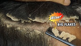 Itchy Scalp Dandruff Removal Satisfying 560 [upl. by Skipton]