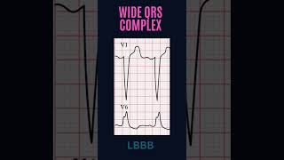 ECG FUNDAMENTALS FOR BEGINNERS QRS COMPLEX [upl. by Munster]