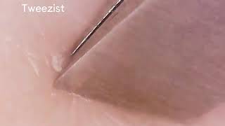 Ingrown hair under scab removal [upl. by Kaitlyn729]