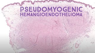 Pseudomyogenic hemangioendothelioma epithelioid sarcoma mimicAustralasian Dermpath 2022 Case 10 [upl. by Pansir]