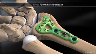 Distal Radius Fracture Repair [upl. by Weissman296]