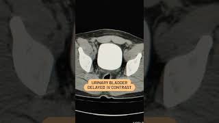 Urinary Bladder Delayed IV Contrast viral biology ctscan [upl. by Odlanier72]