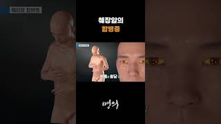 췌장암의 합병증 [upl. by Robb]