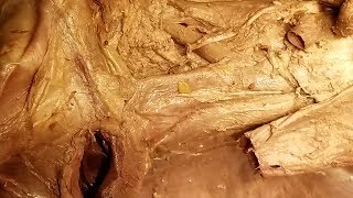 Aorta  Vena Cava  Azygos Vein  Cisterna Chyli Dissection and Clinical Narration – Sanjoy Sanyal [upl. by Floyd278]