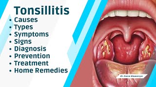 Tonsillitis Causes Types Symptoms Signs Diagnosis Preventions Treatment and Home Remedies [upl. by Herwin743]