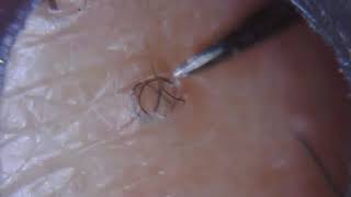 Long ingrown hair removal 23 [upl. by Enila]