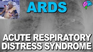 What is ARDS Acute Respiratory Distress Syndrome [upl. by Ahsened]