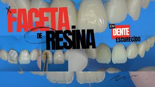 Faceta de Resina Composta em Dente Escurecido [upl. by Yecam]