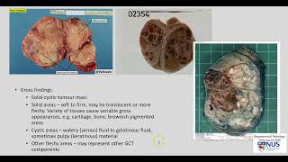 Testis  Teratoma Gross pathology [upl. by Ahsiek]