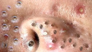 blackheads new 2023  popping pimple today  blackheads and whiteheads removal [upl. by Bashee165]