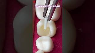 Onlay Teeth Restoration dentistteeth satisfying [upl. by Nicholle]