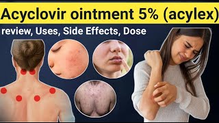 Acyclovir Ointment Uses  Review Acylex ointment uses Side effects contraindications [upl. by Suiravaj849]