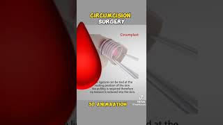 Understanding Circumcision Animated Surgery amp Real Insightsquot [upl. by Naugan]