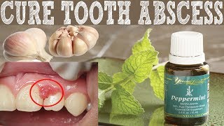 How To Cure Tooth Abscess naturally  Home Remedies To Cure Tooth Abscess [upl. by Aehc]