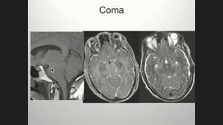 M Marcel Maya MD  Imaging in Intracranial Hypotension [upl. by Hoeve]