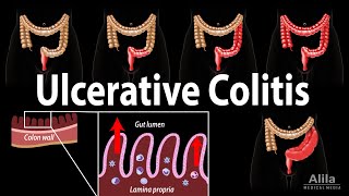 Ulcerative Colitis Pathophysiology Symptoms Risk factors Diagnosis and Treatments Animation [upl. by Yleek794]