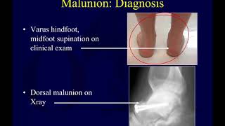 Talus fractures 3  complications of talar neck fx OTA lecture series III l14c [upl. by Dwinnell]