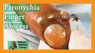 Paronychia Fingernail Abscess Infection Treatment  Auburn Medical Group [upl. by Darla97]