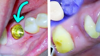 🦷 Dental Bridge vs Implant Dentist Explains Pros Cons amp How Each Is Done [upl. by Bryner]