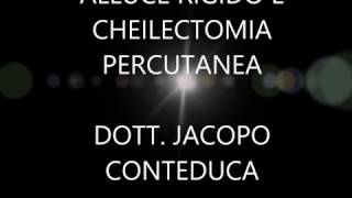 cheilectomia percutanea per alluce rigido Dott Jacopo Conteduca [upl. by Nela]