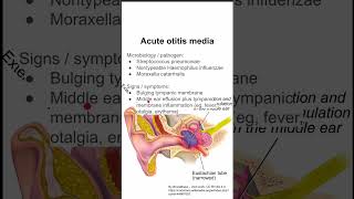 Acute otitis media [upl. by Osnofledi334]