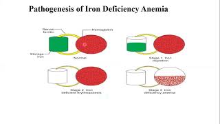 Pathogenesis of Iron Deficiency Anemia Part III Cashirki 9aad [upl. by Treacy261]