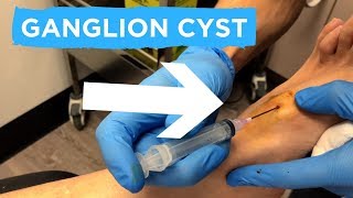 A GANGLION CYST ASPIRATION [upl. by Billy643]