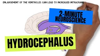 2Minute Neuroscience Hydrocephalus [upl. by Nanreh]