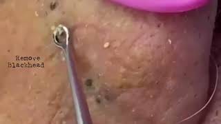 Acne Removal Remove blackhead on his lips noses removeblackhead [upl. by Socram]