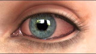 Conjunctivochalasis CCH Dry Eye Animation [upl. by Lodge993]