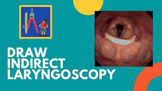 Draw Indirect Laryngoscopy Findings [upl. by Anyat]