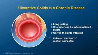 What is Ulcerative Colitis [upl. by Yaja400]