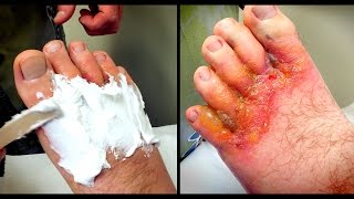 HORRIBLE FOOT RASH Wound Care  Dr Paul [upl. by Renba166]