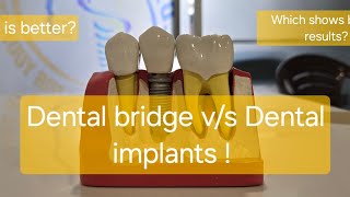 Dental bridge vs Dental implants [upl. by Adnorahs382]