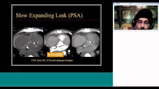 PostOperative Aorta and Stent Graft Imaging by Prof Satinder Singh [upl. by Ynej]