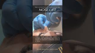 Nose Lift the solution to your asymmetrical or crooked nose [upl. by Septima]